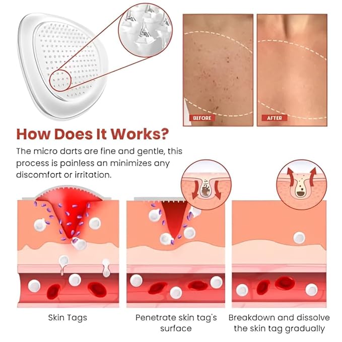 MegaMall™ | Skin Tags Remover Patch